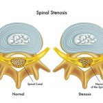 腰痛と脊柱管狭窄症について